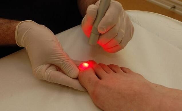 Laser Behandlung fir Zehennagelpilz