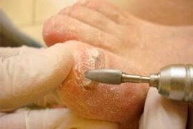 Mechanesch Verpflichtung vun der Neelplack
