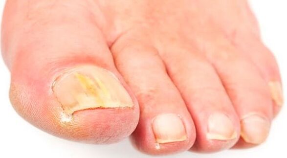 Nail filgus