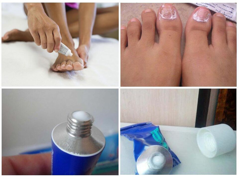 effektiv pharmazeutesch Preparatiounen géint Nagelpilz